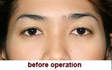 plastic-surgery-blepharoplasty